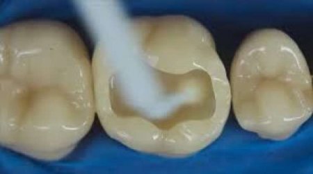 Diş ağrısını 1 dəqiqəyə yox edən təbii üsullar - 5 ÇARƏ